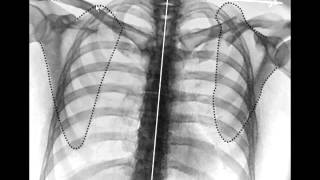 Clavicle Fractures [upl. by Gewirtz]