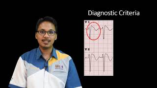 ECG in Brugada syndrome [upl. by Nenerb]