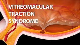 Vitreomacular Traction Syndrome [upl. by Aicilana650]