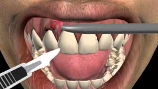 How to treat a tooth abscess [upl. by Oos]