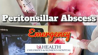 Peritonsillar Abscess Emergency and Needle Aspiration [upl. by Nodnahs]