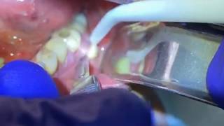 Draining a Dental Abscess  Advanced Dental Care [upl. by Hardan]