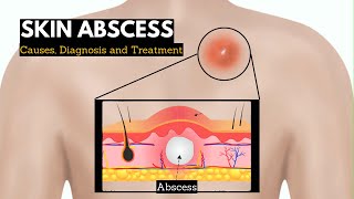 Skin Abscess Causes Signs and Symptoms Diagnosis and Treatment [upl. by Snehpets87]