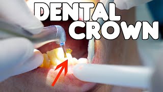 Dental Crown Procedure EXPLAINED [upl. by Stets]