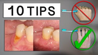 10 Tips to Minimize Gum Recession at Home [upl. by Nered]