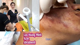 Acne treatment reputation effective at Hien Van Spa383I Lưu hoàng Minhpart4 [upl. by Hawker]