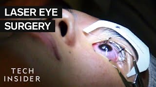 What Its Like To Get Laser Eye Surgery [upl. by Resor]