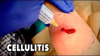 ABSCESS WITH CELLULITIS We had to drain it  Dr Paul [upl. by Nosemaj]