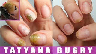 How I Cured My Nails  Shocking Experience  Restoring Nails from Bacteria [upl. by Kliman]