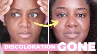 How I Got Rid of My Dark Circles Black Skin [upl. by Antoinette]