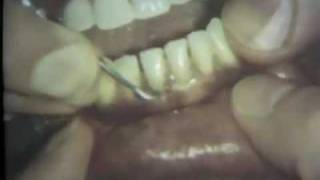 Scaling and Root Planing Part II Mandibular Teeth [upl. by Orlina]