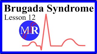 Pedro Brugada PhD talked about Brugada Syndrome during his visit at Vall dHebron [upl. by Haskell]