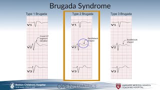 Brugada Syndrome by G Dhillon  OPENPediatrics [upl. by Ahseenat72]