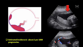 Minute Lecture  The placenta the inside story of pregnancy [upl. by Henghold]