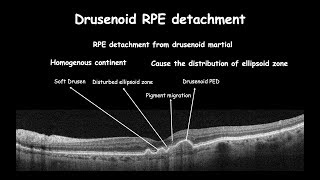 Clinical changes in RPE course  Drusen [upl. by Elisabet423]