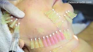 Thread Lifting 4D Mesotherapy [upl. by Ehman]