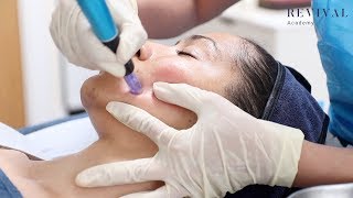 Microneedling Full Training Video [upl. by Nylecyoj]