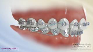 Elastics  Class II Triangle 3 to 46  Orthodontic Treatment [upl. by Brenner]