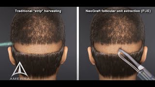 What is the NeoGraft FUE Hair Transplant System [upl. by Oilegor]