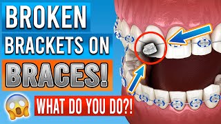 Broken Braces Brackets What You Need To Know [upl. by Ramedlab]