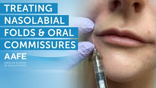 Using Dermal Fillers to Fill and Smooth Smile Lines  AAFE [upl. by Yelmene]