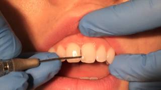 Periodontal Probing [upl. by Letnoj]