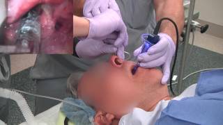 Twisting ETT during nasal intubation from AOD [upl. by Bazil]