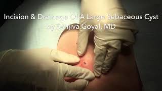 Incision amp Drainage of a Large Sebaceous Cyst [upl. by Myra]