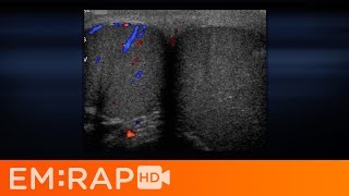 Ultrasound of Testicular Torsion [upl. by Kindig]