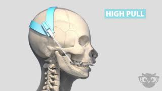 Headgear For Overbite [upl. by Chancellor]