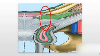 Inguinal Hernias Explained [upl. by Lothar]