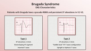 EKGECG  Brugada Syndrome Type 1  The EKG Guy  wwwEKGmd [upl. by Johnstone]