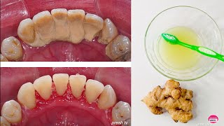 How to Remove Tartar from Teeth at home naturally  Natural Ways to Remove Tartar Buildup [upl. by Brackely]