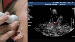 How To Transcranial Doppler [upl. by Aliban]