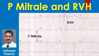 ECG Interpretation Tutorial  ChalkTalk 08  Basic Level [upl. by Arber]