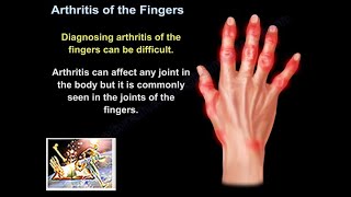 Arthritis Of The Fingers  Everything You Need To Know  Dr Nabil Ebraheim [upl. by Tamaru]