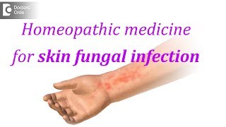 Homeopathic medicine for skin fungal infection  Dr Surekha Tiwari [upl. by Laenaj]