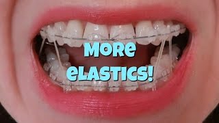 How I put my Braces Elastics on [upl. by Atteynot]