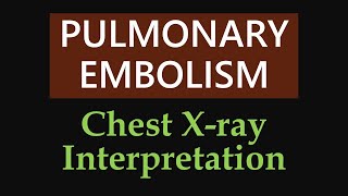 Pulmonary Embolism  Chest Xray Interpretation [upl. by Ahsinoj]