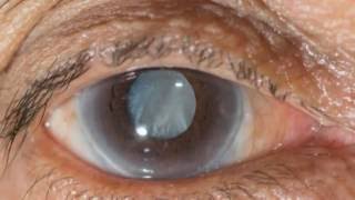 The Warning Signs of Cataracts [upl. by Innavoij]