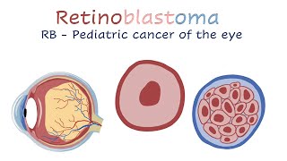 Retinoblastoma [upl. by Anilosi]