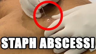 STAPH ABSCESS 🦠 [upl. by Arlon125]