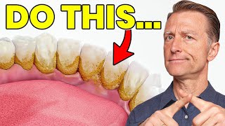 The 1 Top Remedy for Dental Plaque TARTAR [upl. by Irving]