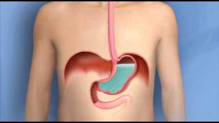 Swallowing Disorders and Achalasia [upl. by Travax]