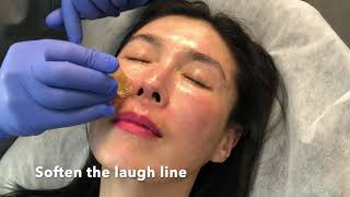 Meso Botox Filler Facial Rejuvenation  Omeed Sani MD  Sani Aesthetics [upl. by Vitia]