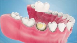 Dental Crown Procedure [upl. by Ahsiuqet]