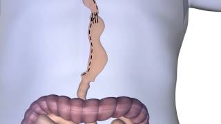 Barium Swallow Esophageal Pathologies [upl. by Siduhey957]