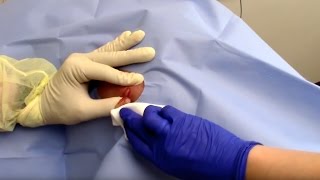 Abscess Drainage Performed by Dermatologist Dr David Myers [upl. by Kcirrez150]