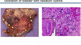 Radiation Treatment for Brain Tumor full procedure [upl. by Vala]