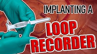 How To Do A Bone Marrow Aspiration amp Biopsy [upl. by Harp]